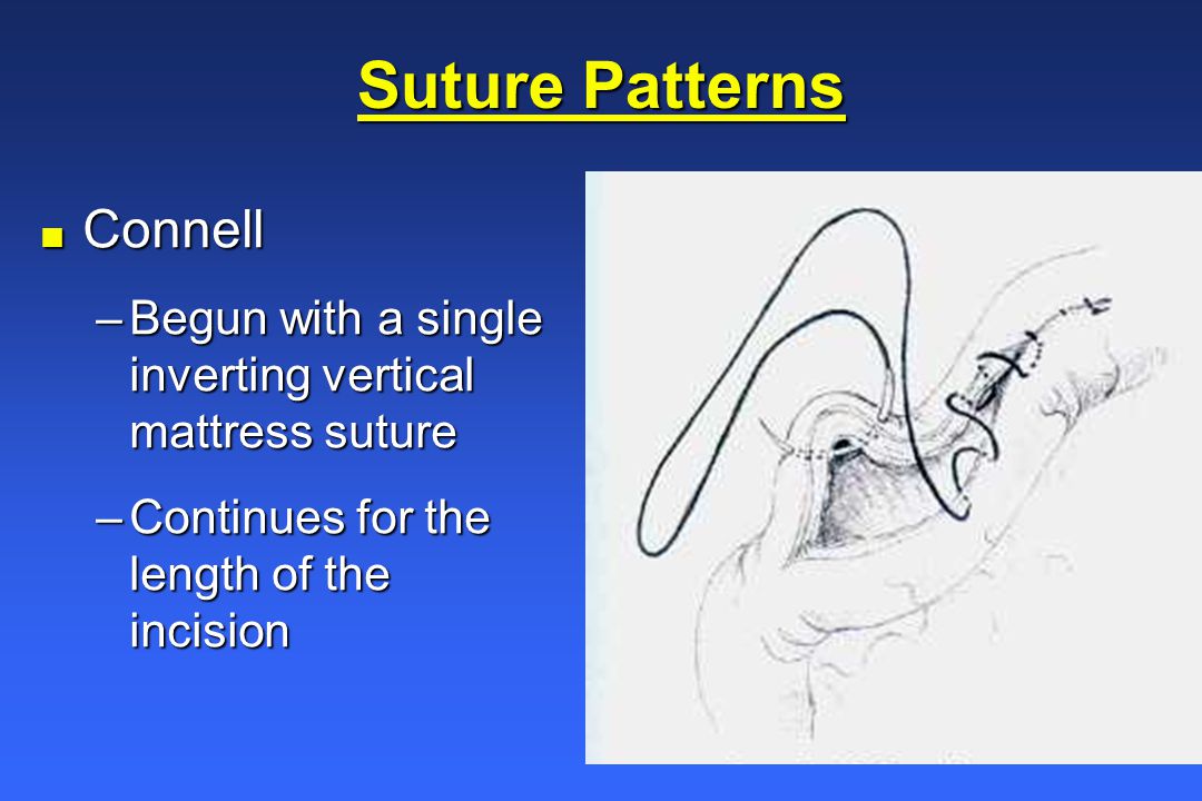Connell suture sale